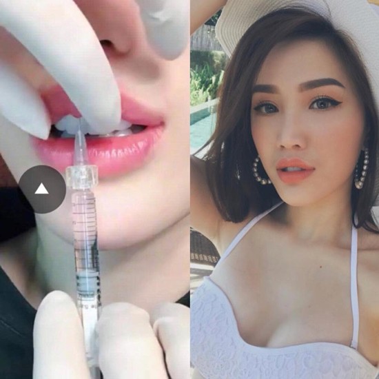 Lộ ảnh được cho là Bảo Thy đi tiêm môi căng mọng, khác hẳn ngoại hình trong quá khứ - Ảnh 1. Lộ ảnh được cho là Bảo Thy đi tiêm môi căng mọng, khác hẳn ngoại hình trong quá khứ - Ảnh 1.